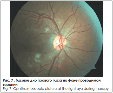 Глазное дно правого глаза на фоне проводимой терапии