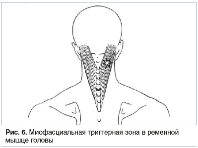 Рис. 6. Миофасциальная триггерная зона в ременной мышце головы