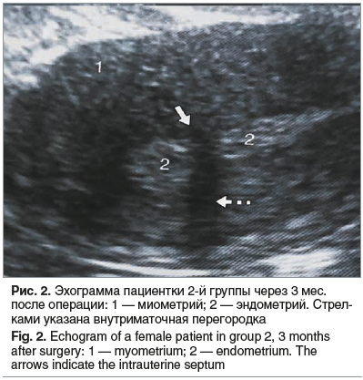 Рис. 2. Эхограмма пациентки 2-й группы через 3 мес. после операции: 1 — миометрий; 2 — эндометрий. Стрел- ками указана внутриматочная перегородка Fig. 2. Echogram of a female patient in group 2, 3 months after surgery: 1 — myometrium; 2 — endometrium. The