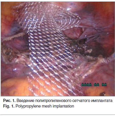 Рис. 1. Введение полипропиленового сетчатого имплантата Fig. 1. Polypropylene mesh implantation