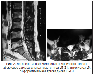 Рис. 2. Дегенеративные изменения поясничного отдела:а) склероз замыкательных пластин тел L5-S1, антелистез L5;б) фораминальная грыжа диска L5-S1