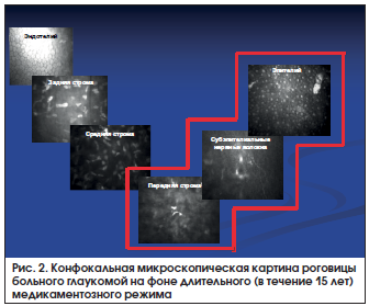 Рис. 2. Конфокальная микроскопическая картина роговицы больного глаукомой на фоне длительного (в течение 15 лет) медикаментозного режима