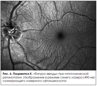 Рис. 6. Пациентка К. «Фигура звезды» при гипотонической ретинопатии. Изображение в режиме синего лазера (490 нм) сканирующего лазерного офтальмоскопа