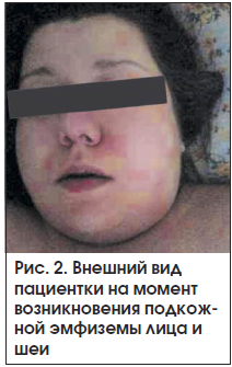 Рис. 2. Внешний вид пациентки на момент возникновения подкожной эмфиземы лица и шеи