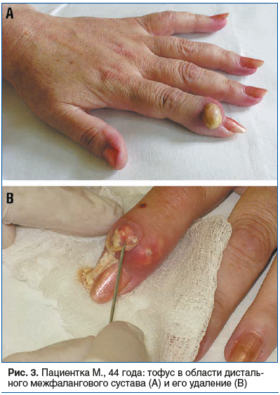 Рис. 3. Пациентка М., 44 года: тофус в области дистального межфалангового сустава (А) и его удаление (B)