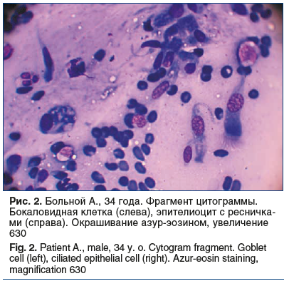 Рис. 2. Больной А., 34 года. Фрагмент цитограммы. Бокаловидная клетка (слева), эпителиоцит с ресничка- ми (справа). Окрашивание азур-эозином, увеличение 630 Fig. 2. Patient A., male, 34 y. o. Cytogram fragment. Goblet cell (left), ciliated epithelial cell