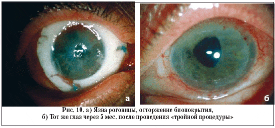 Рис. 10. а) Язва роговицы, отторжение биопокрытия, б) Тот же глаз через 5 мес. после проведения «тройной процедуры»