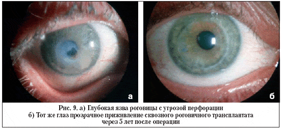 Рис. 9. а) Глубокая язва роговицы с угрозой перфорации б) Тот же глаз прозрачное приживление сквозного роговичного трансплантата через 5 лет после операции
