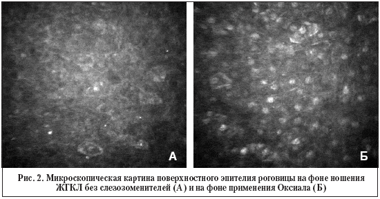 Рис. 2. Микроскопическая картина поверхностного эпителия роговицы на фоне ношения ЖГКЛ без слезозоменителей (А) и на фоне применения Оксиала (Б)