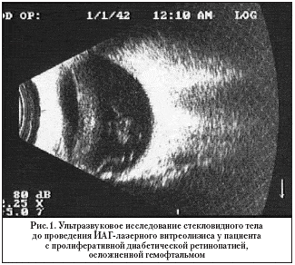 Рис.1. Ультразвуковое исследование стекловидного тела до проведения ИАГ-лазерного витреолизиса у пациента с пролиферативной диабетической ретинопатией, осложненной гемофтальмом