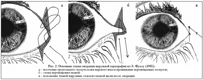 Рис. 2. Основные этапы операции наружной тарзорафии по Э. Фуксу (1905):