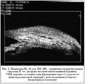Рис. 2. Пациентка М., 61 год. DS: OD – первичная открытоугольная глаукома II «с» (на фоне местной гипотензивной терапии).
