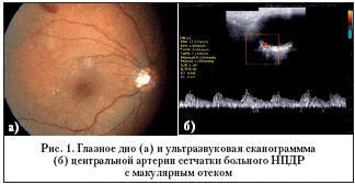 Рис. 1. Глазное дно (а) и ультразвуковая сканограммма (б) центральной артерии сетчатки больного НПДР с макулярным отеком