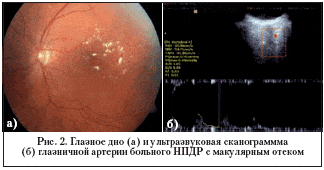 Рис. 2. Глазное дно (а) и ультразвуковая сканограммма (б) глазничной артерии больного НПДР с макулярным отеком