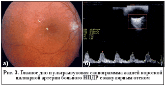 Рис. 3. Глазное дно и ультразвуковая сканограммма задней короткой цилиарной артерии больного НПДР с макулярным отеком