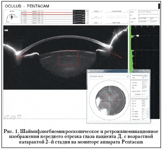 Рис. 1. Шаймпфлюгбиомикроскопическое и ретроиллюминационное изображения переднего отрезка глаза пациента Д. с возрастной катарактой 2–й стадии на мониторе аппарата Pentacam