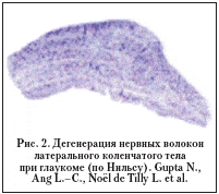 Рис. 2. Дегенерация нервных волокон латерального коленчатого тела при глаукоме (по Нильсу). Gupta N., Ang L.–C., Noёl de Tilly L. et al.