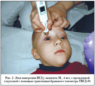 Рис. 2. Этап измерения ВГД у пациента М., 4 лет, с врожденной глаукомой с помощью транспальпебрального тонометра ТВГД-01