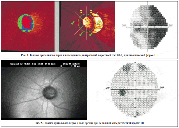 Рис. 1. Головка зрительного нерва и поле зрения (центральный пороговый тест 30-2) при миопической форме НГ