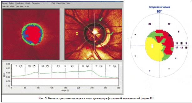 Рис. 3. Головка зрительного нерва и поле зрения при фокальной ишемической форме НГ