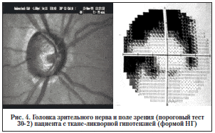 Рис. 4. Головка зрительного нерва и поле зрения (пороговый тест 30-2) пациента с ткане-ликворной гипотензией (формой НГ)