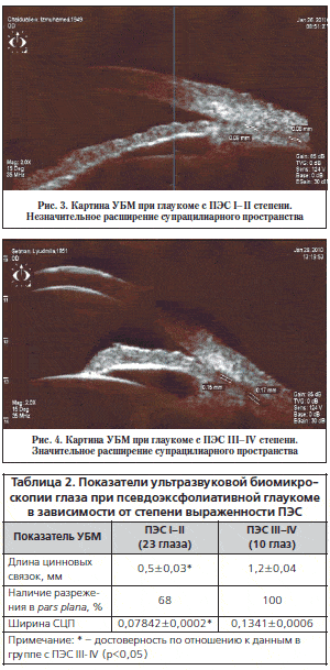Рис. 3. Картина УБМ при глаукоме с ПЭС I–II степени. Незначительное расширение супрацилиарного пространства