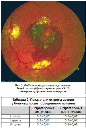 Рис. 2. ФАГ глазного дна пациента до лечения. Левый глаз – субфовеолярная скрытая ХНВ, обширные субретинальные геморрагии