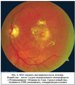 Рис. 3. ФАГ глазного дна пациента после лечения. Левый глаз – после 1 курса эндоназального электрофореза с Ретиналамином + Неванак по 2 кап. 3 раза в левый глаз. Активность ХНВ уменьшилась, геморрагии рассосались