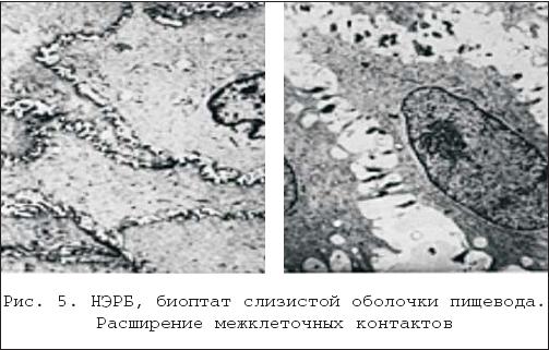Биоптат слизистой оболочки. Неэрозивной рефлюксной болезнью (НЭРБ. Неэрозивную рефлюксную болезнь (НЭРБ). Неэрозивный ГЭРБ микроскопия. Неэрозивная форма нк1 ст.