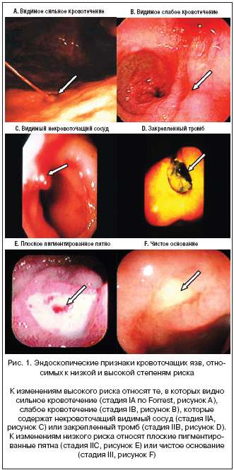 Рис. 1. Эндоскопические признаки кровоточащих язв, отно- симых к низкой и высокой степеням риска