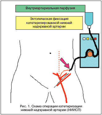 Рис. 1. Схема операции катетеризации нижней надчревной артерии (НИИСП)
