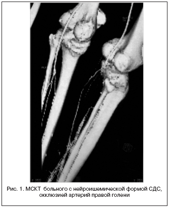 Рис. 1. МСКТ больного с нейроишемической формой СДС, окклюзией артерий правой голени