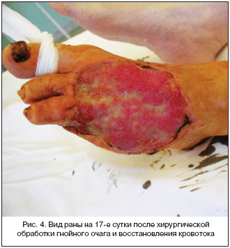 Рис. 4. Вид раны на 17-е сутки после хирургической обработки гнойного очага и восстановления кровотока