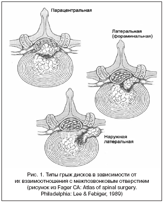Рис. 1. Типы грыж дисков в зависимости от их взаимоотношения с межпозвонковым отверстием (рисунок из Fager CA: Atlas of spinal surgery. Philadelphia: Lee & Febiger, 1989)