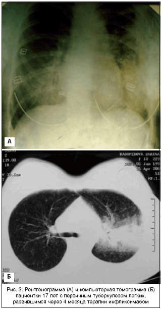 Рис. 3. Рентгенограмма (А) и компьютерная томограмма (Б) пациентки 17 лет с первичным туберкулезом легких, развившимся через 4 месяца терапии инфликсимабом