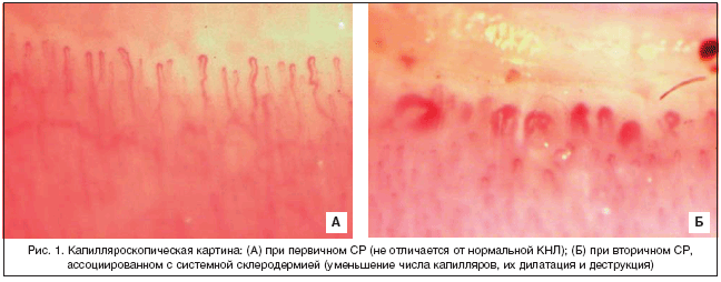 Рис. 1. Капилляроскопическая картина: (А) при первичном СР (не отличается от нормальной КНЛ); (Б) при вторичном СР, ассоциированном с системной склеродермией (уменьшение числа капилляров, их дилатация и деструкция)