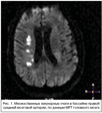 Рис. 1. Множественные лакунарные очаги в бассейне правой средней мозговой артерии, по данным МРТ головного мозга