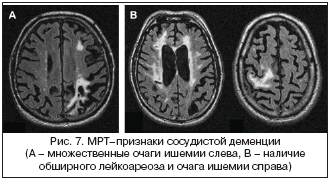 Рис. 7. МРТ–признаки сосудистой деменции (А – множественные очаги ишемии слева, B – наличие обширного лейкоареоза и очага ишемии справа)