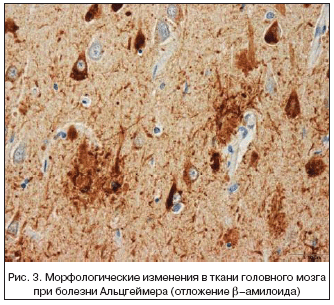 Рис. 3. Морфологические изменения в ткани головного мозга при болезни Альцгеймера (отложение β–амилоида)