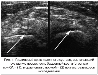 Рис. 1. Гиалиновый хрящ коленного сустава, выстилающий суставную поверхность бедренной кости (стрелки) при ОА – (1), в сравнении с нормой – (2) при ультразвуковом исследовании