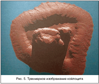 Рис. 5. Трехмерное изображение койлоцита