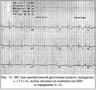 Рис. 12. ЭКГ при аритмогенной дисплазии правого желудочка. (–) Т V1–V4, волна эпсилон за комплексом QRS в отведениях V1–V3