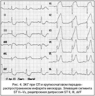Рис. 4. ЭКГ при СП и крупноочаговом передне–распространенном инфаркте миокарда. Элевация сегмента ST V1–V5, реципрокная депрессия ST II, III, aVF