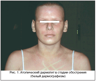 Рис. 1. Атопический дерматит в стадии обострения (белый дермографизм)