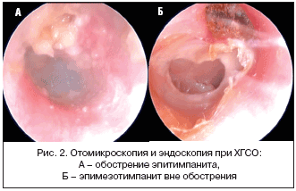 Рис. 2. Отомикроскопия и эндоскопия при ХГСО