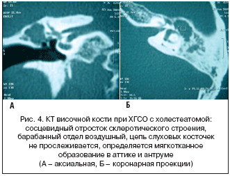 Рис. 4. КТ височной кости при ХГСО с холестеатомой