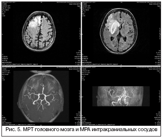 Рис. 5. МРТ головного мозга и МРА интракраниальных сосудов