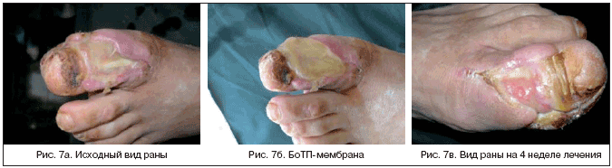 Рис. 7а. Исходный вид раны Рис. 7б. БоТП-мембрана Рис. 7в. Вид раны на 4 неделе лечения