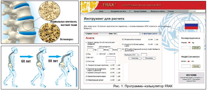 Рис. 1. Программа–калькулятор FRAX