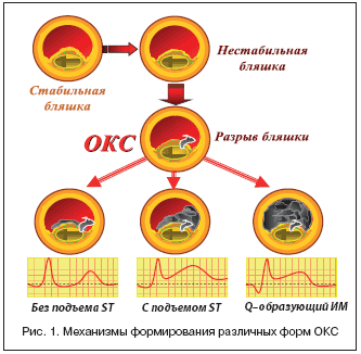 Рис. 1. Механизмы формирования различных форм ОКС